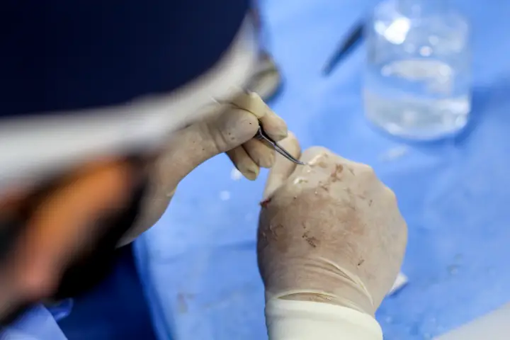 Transplante de barba