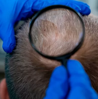 Alopecia - THT Hair Transplant