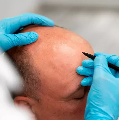 Calvície Masculina e Feminina - THT Hair Transplant